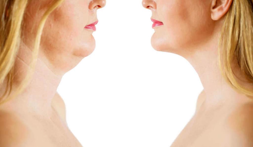 Double Chin treatment Cranleigh before and after results