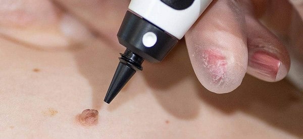 After Skin Tag Removal Cranleigh