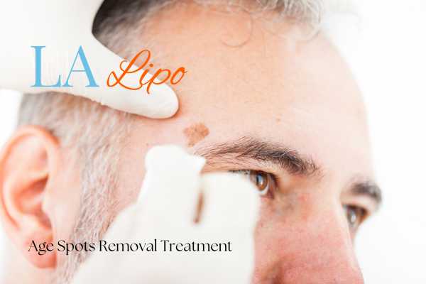 What Are the Most Effective Treatments for Age Spots Cranleigh?
