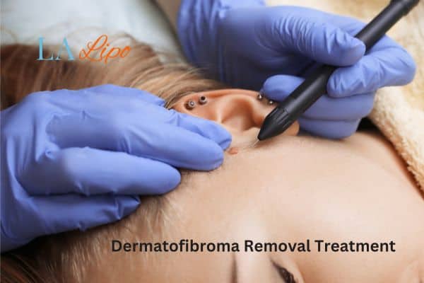Dermatofibroma Removal Treatment Cranleigh