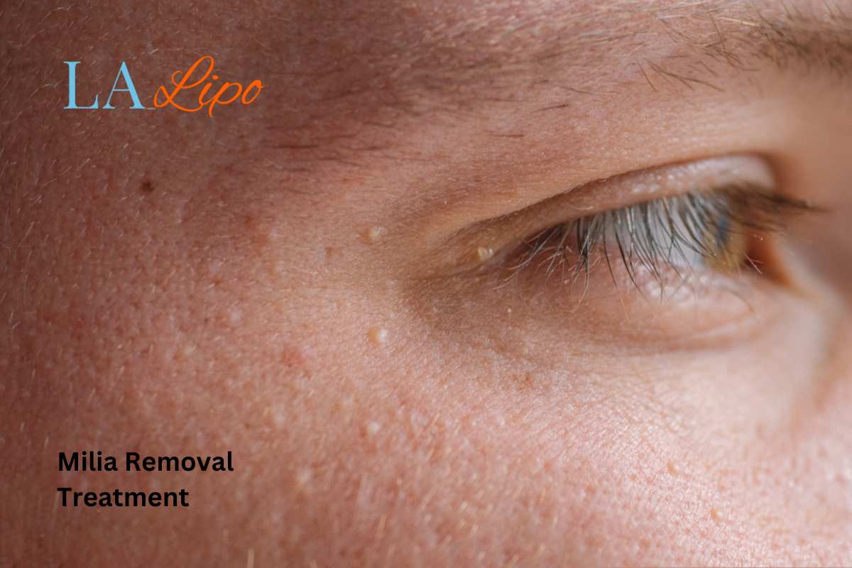 Cryopen Milia Removal: Is It the Easiest and Safest Option Cranleigh?