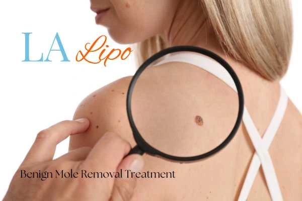 Woman having her inspection of blemish before mole removal Cranleigh