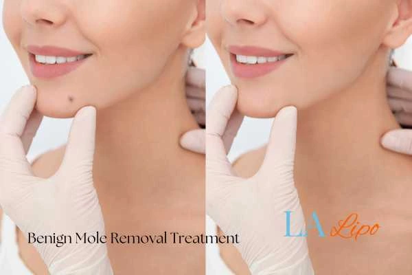 Before and after mole removal Cranleigh treatment