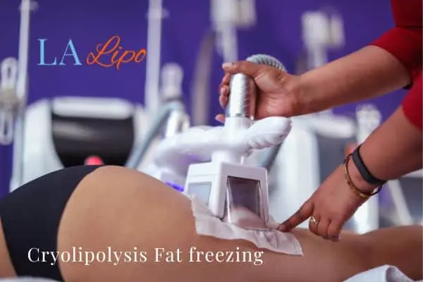 women getting fat freezing Cranleigh