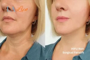 hi-fu for wrinkles Cranleigh before and after results
