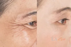 Before and after results of woman - HI-fu wrinkles reduction treatment Cranleigh