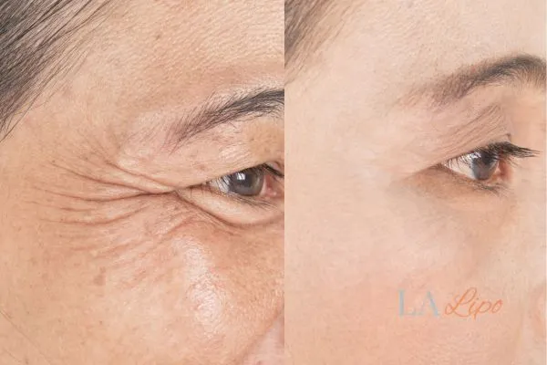 Before and after results of woman - HI-fu wrinkles reduction treatment Cranleigh