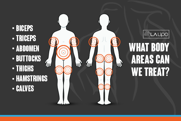 Graphic to show areas you can have LA-EMS Body Sculpting Cranleigh treatment.