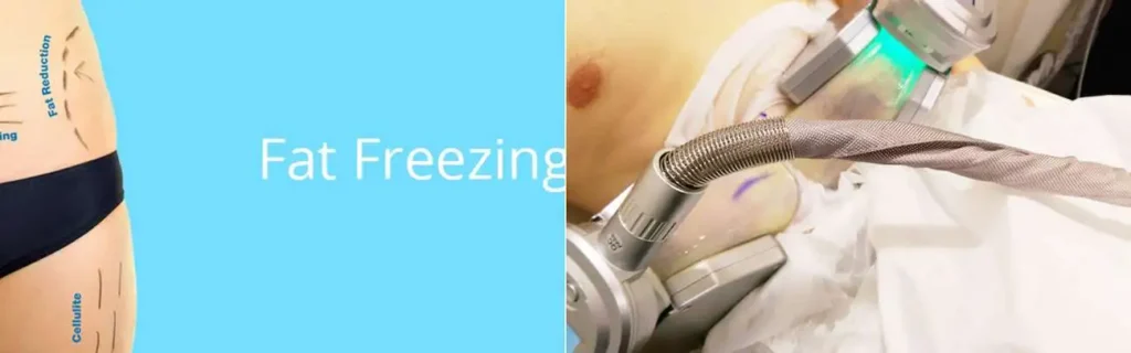 Fat freezing Cranleigh on multiple areas of the body