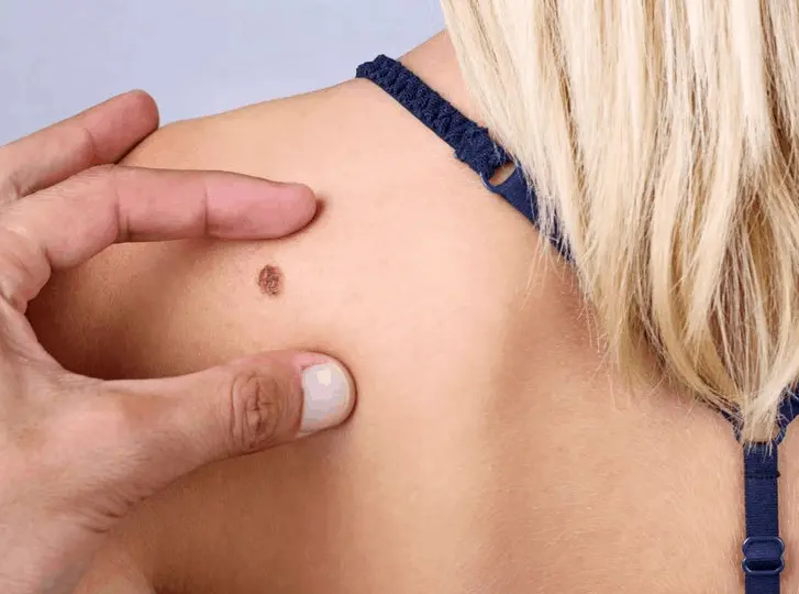woman having mole removal Cranleigh consultation before treatment.