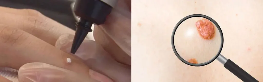 Cryopen for mole removal Cranleigh - speak to our team today!
