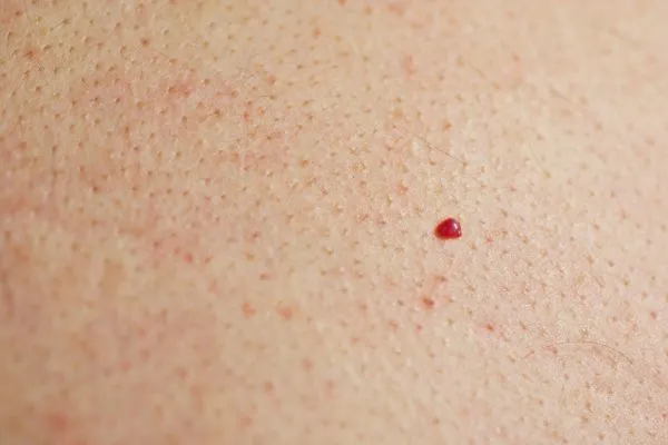 close up of a cherry angioma Cranleigh