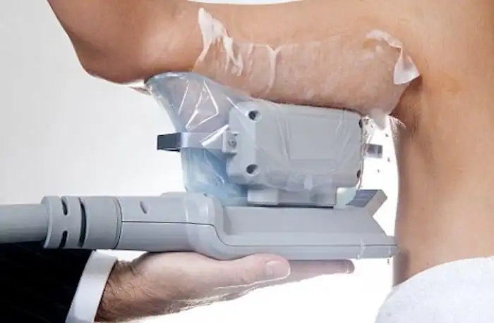 Picture of fat freezing Cranleigh on the upper arms.