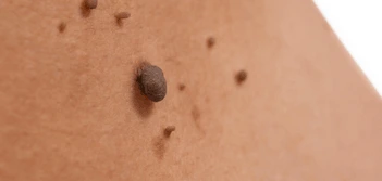 image of a skin tag Cranleigh