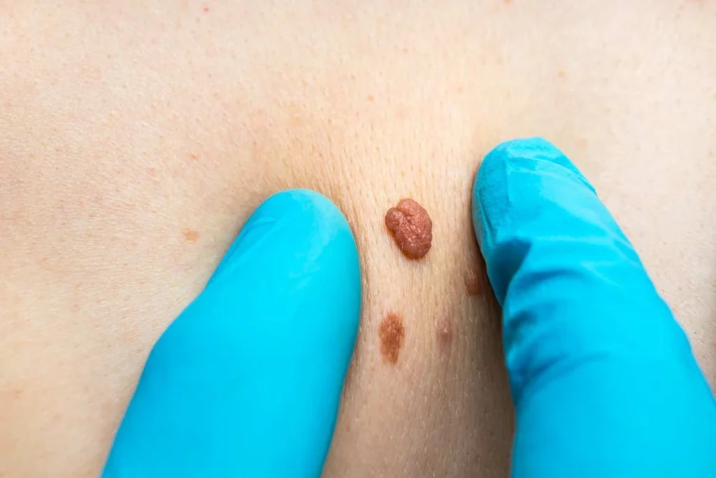 Consultant examining a skin tag Cranleigh