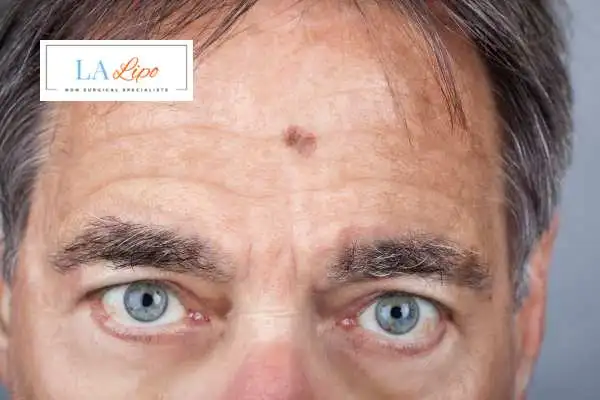 Solar Lentigo Removal Cranleigh image of man with mark on his forehead