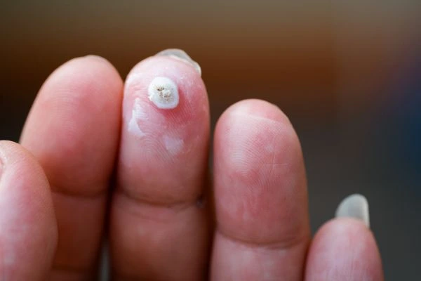 wart on person finger - cryotherapy to treat from LA LIPO Cranleigh