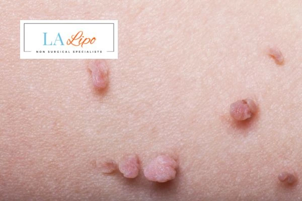 Does cryopen skin tag removal Cranleigh hurt? Find out now call our team today!