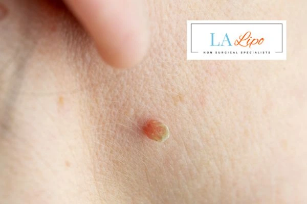 Book skin tag removal Cranleigh today speak to our team now!