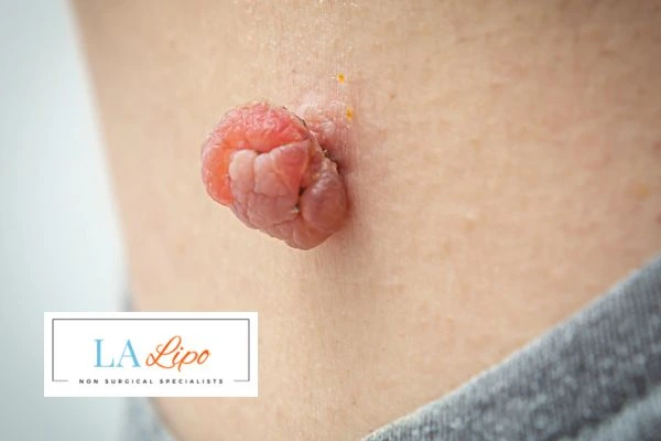 Interested in skin tag removal Cranleigh? Concerned about the pain? Find out more today!
