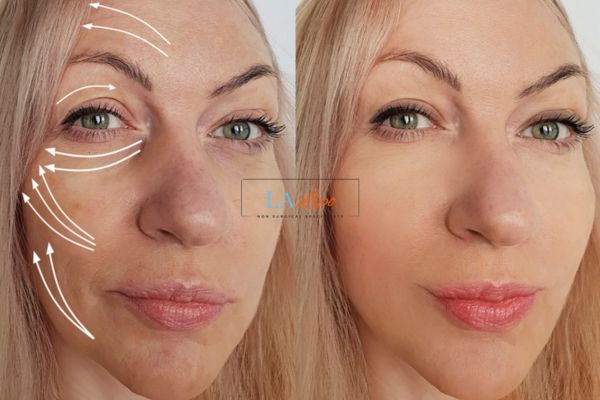 Morpheus 8 results Cranleigh face lift.