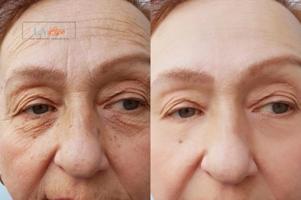 The powerful benefits of Morpheus8 Treatment Cranleigh - Call Our team today!