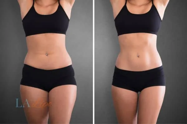before and after results of non-surgical treatment to help a woman's body image and mental health Cranleigh