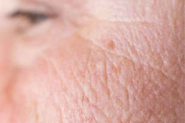 close up picture of a woman's face showing an age spot Cranleigh
