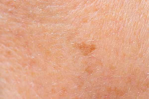 close up picture of age spots Cranleigh