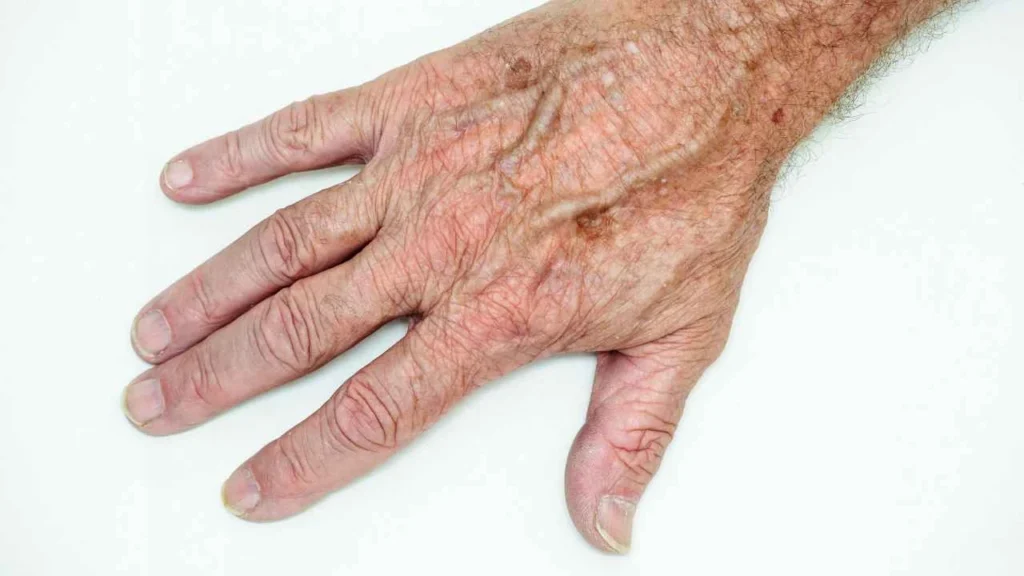 Male hand showing age spot Cranleigh