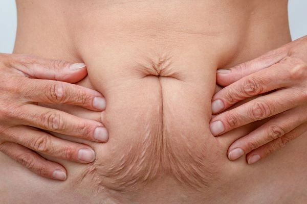 Should I Combine Diastasis Recti Treatment with Body Contouring for Better Results Cranleigh?