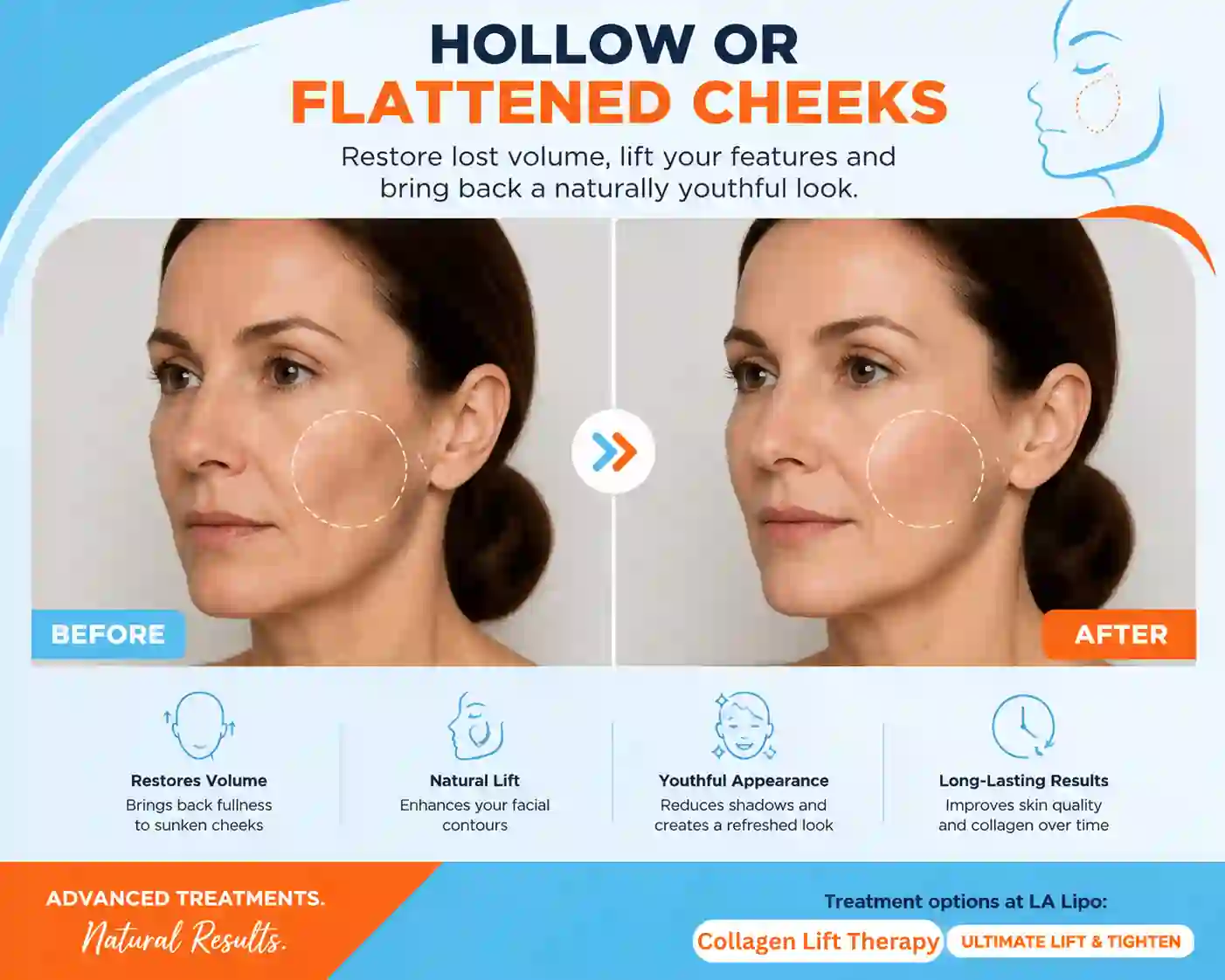 Sign #4: Hollow or Flattened Cheeks Cranleigh