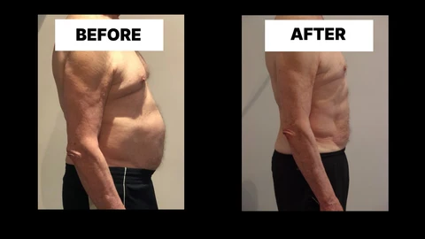 What Symptoms Can Diastasis Recti Cause in Men? Weak Core, Back Pain and Poor Posture Cranleigh